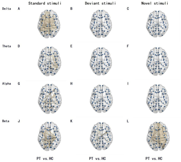 Insular Glioma Resection — Figure 2