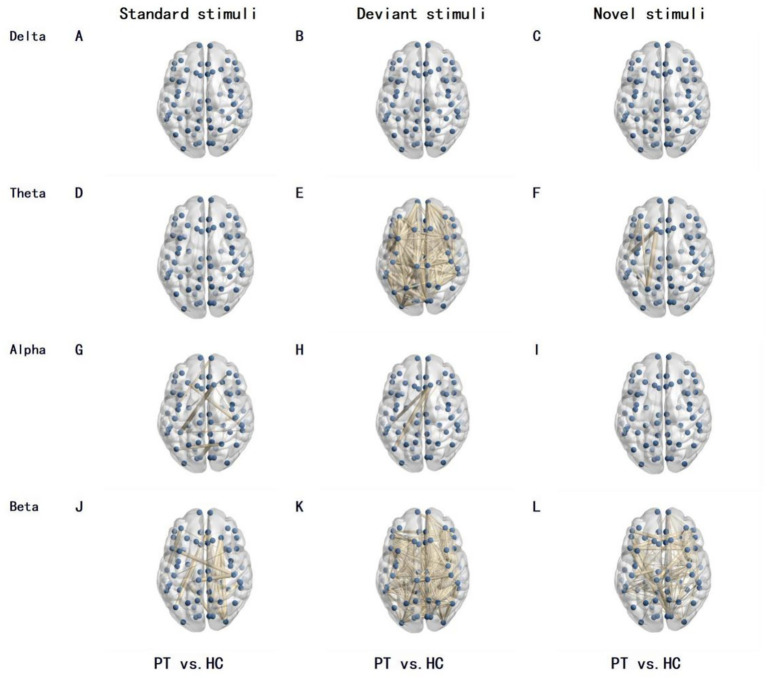 Insular Glioma Resection — Figure 3