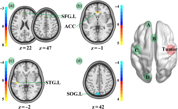 Insular Glioma Resection — FIGURE 6