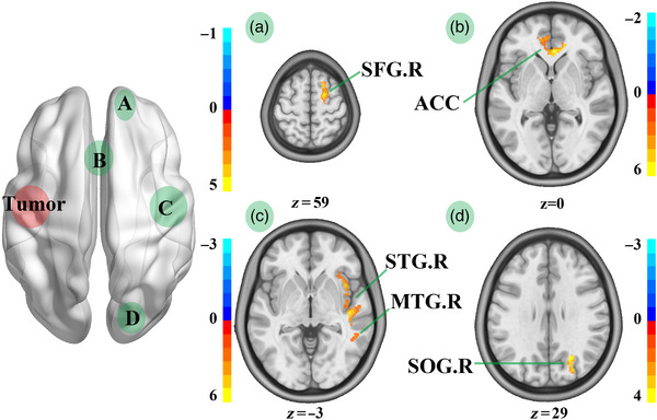 Insular Glioma Resection — FIGURE 5