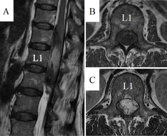 Intradural Extramedullary Spinal Tumor Resection — Figure 1.