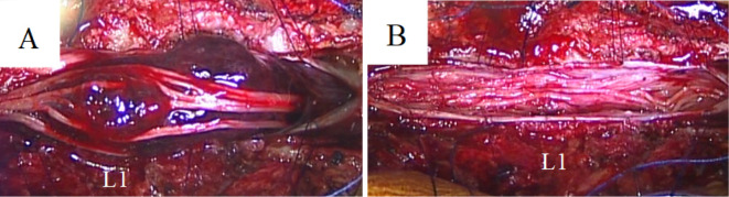 Intradural Extramedullary Spinal Tumor Resection — Figure 2.