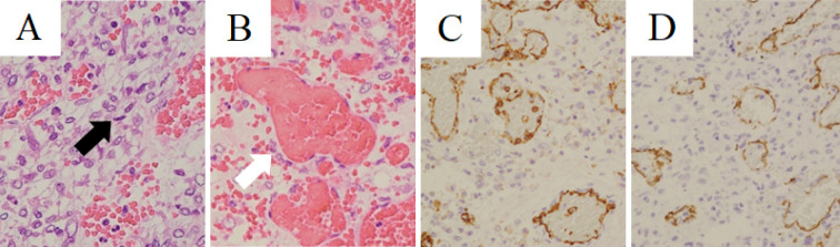 Intradural Extramedullary Spinal Tumor Resection — Figure 3.