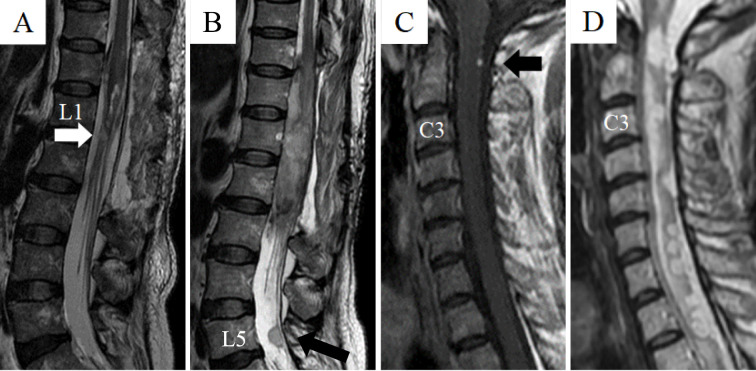 Intradural Extramedullary Spinal Tumor Resection — Figure 4.