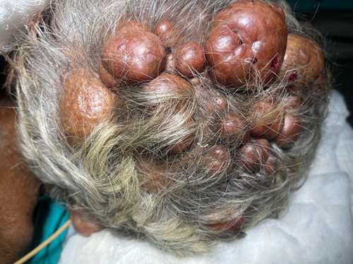 Intradural Extramedullary Spinal Tumor Resection — Figure 1