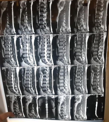 Intradural Extramedullary Spinal Tumor Resection — Figure 2
