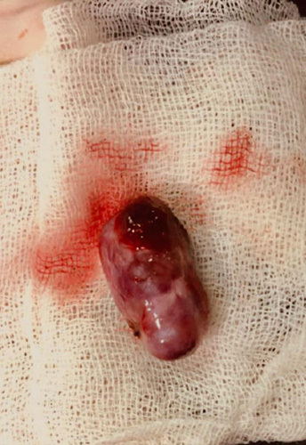 Intradural Extramedullary Spinal Tumor Resection — Figure 3