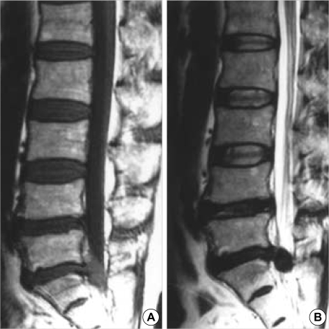 Intradural Extramedullary Spinal Tumor Resection — Fig. 1