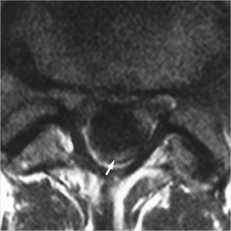 Intradural Extramedullary Spinal Tumor Resection — Fig. 2