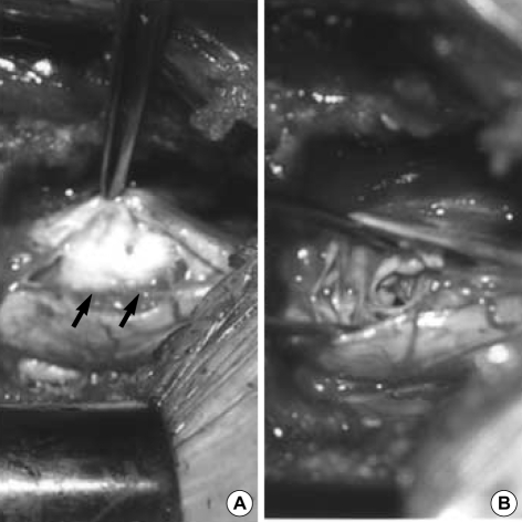 Intradural Extramedullary Spinal Tumor Resection — Fig. 3