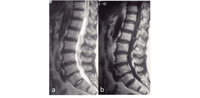 Intramedullary Spinal Cord Tumor Resection — Fig. 1