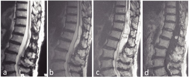 Intramedullary Spinal Cord Tumor Resection — Fig. 2