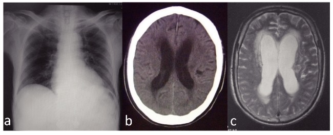 Intramedullary Spinal Cord Tumor Resection — Fig. 3