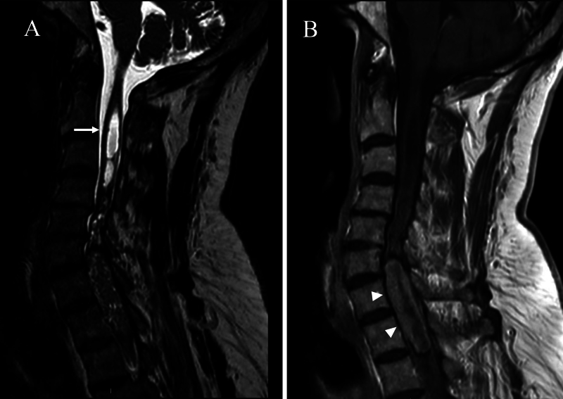 Intramedullary Spinal Cord Tumor Resection — FIG. 1.