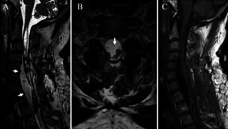 Intramedullary Spinal Cord Tumor Resection — FIG. 2.