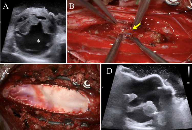 Intramedullary Spinal Cord Tumor Resection — FIG. 3.