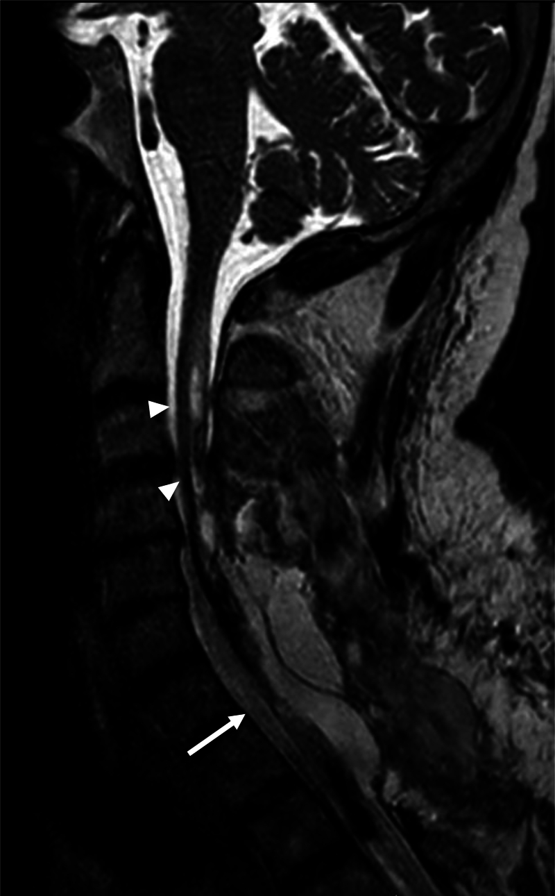 Intramedullary Spinal Cord Tumor Resection — FIG. 4.