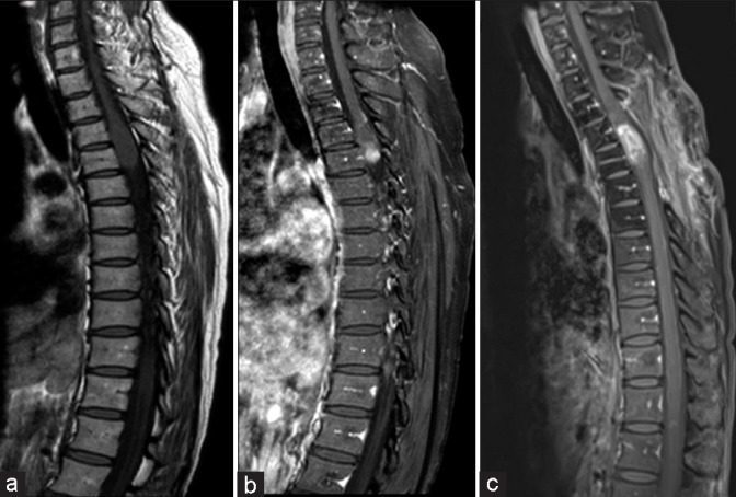 Intramedullary Spinal Cord Tumor Resection — Figure 1: