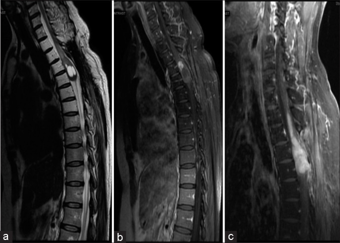 Intramedullary Spinal Cord Tumor Resection — Figure 2: