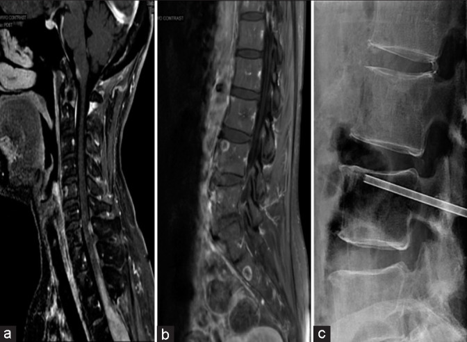 Intramedullary Spinal Cord Tumor Resection — Figure 3: