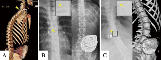 Intrathecal Baclofen Pump Implantation — Fig. 1