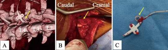 Intrathecal Baclofen Pump Implantation — Fig. 2