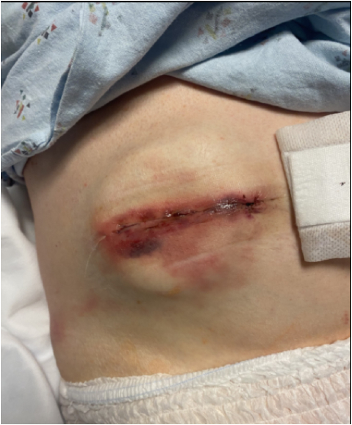 Intrathecal Baclofen Pump Implantation — Fig. 1