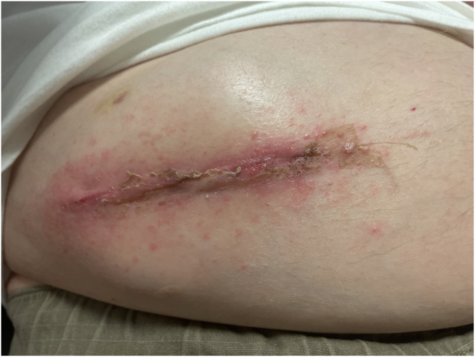 Intrathecal Baclofen Pump Implantation — Fig. 2