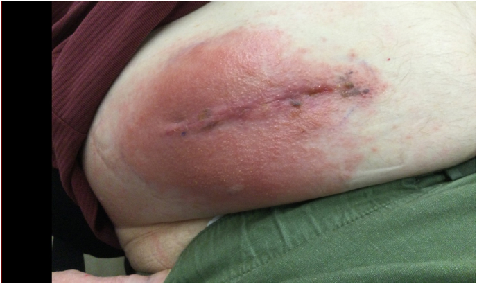 Intrathecal Baclofen Pump Implantation — Fig. 3