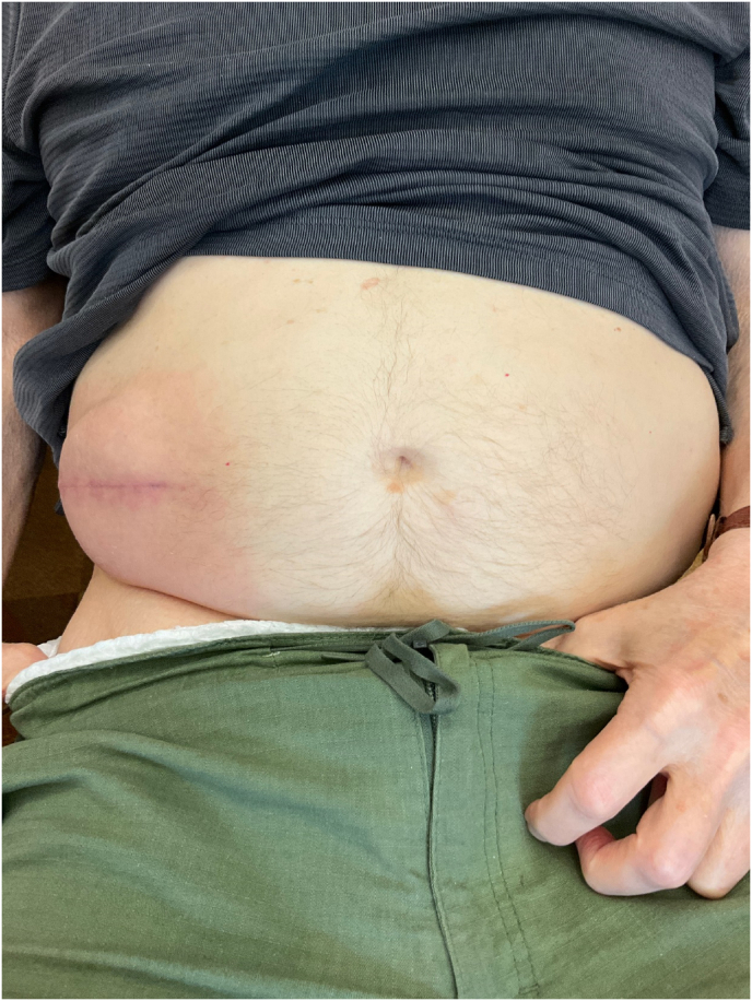 Intrathecal Baclofen Pump Implantation — Fig. 5