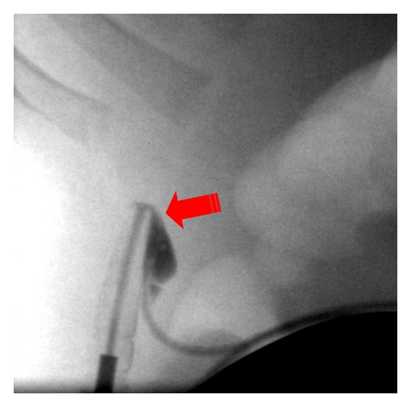 Intrathecal Baclofen Pump Implantation — Figure 1