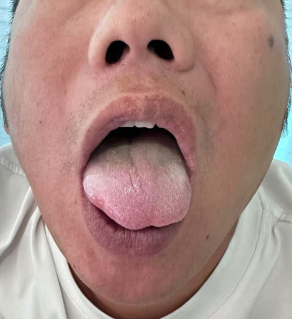 Jugular Foramen Tumor — Figure 1