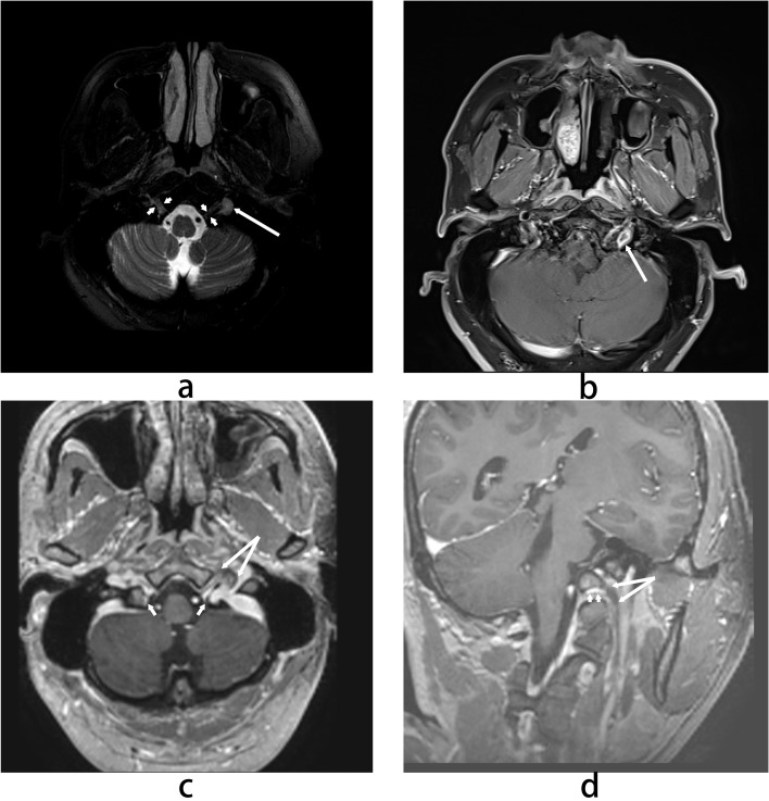 Jugular Foramen Tumor — Figure 2