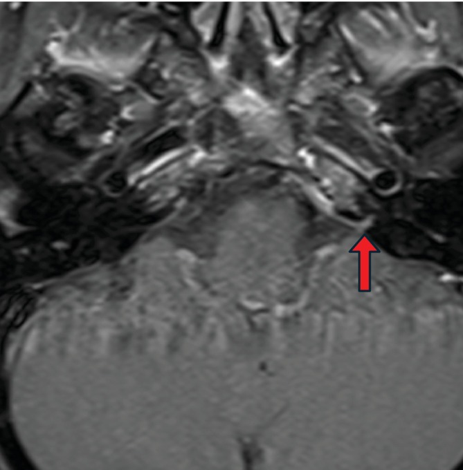 Jugular Foramen Tumor — FIGURE 2