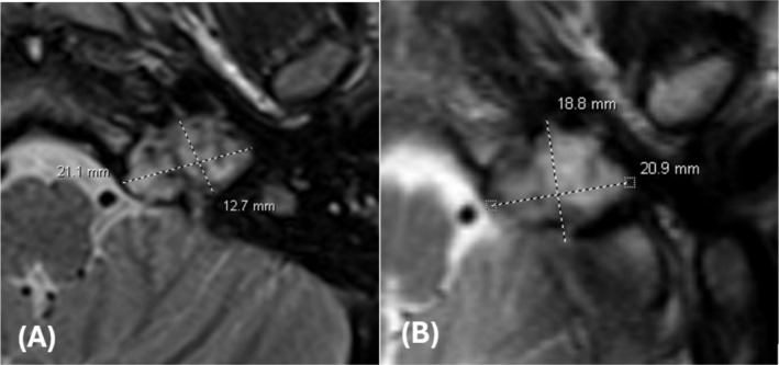 Jugular Foramen Tumor — FIGURE 4