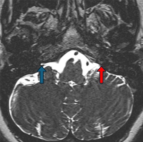 Jugular Foramen Tumor — Figure 7