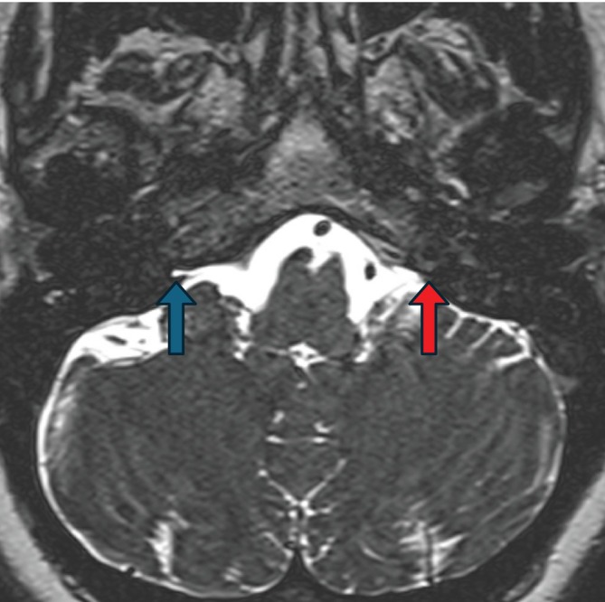 Jugular Foramen Tumor — FIGURE 1