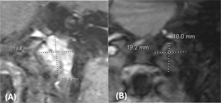 Jugular Foramen Tumor — FIGURE 5