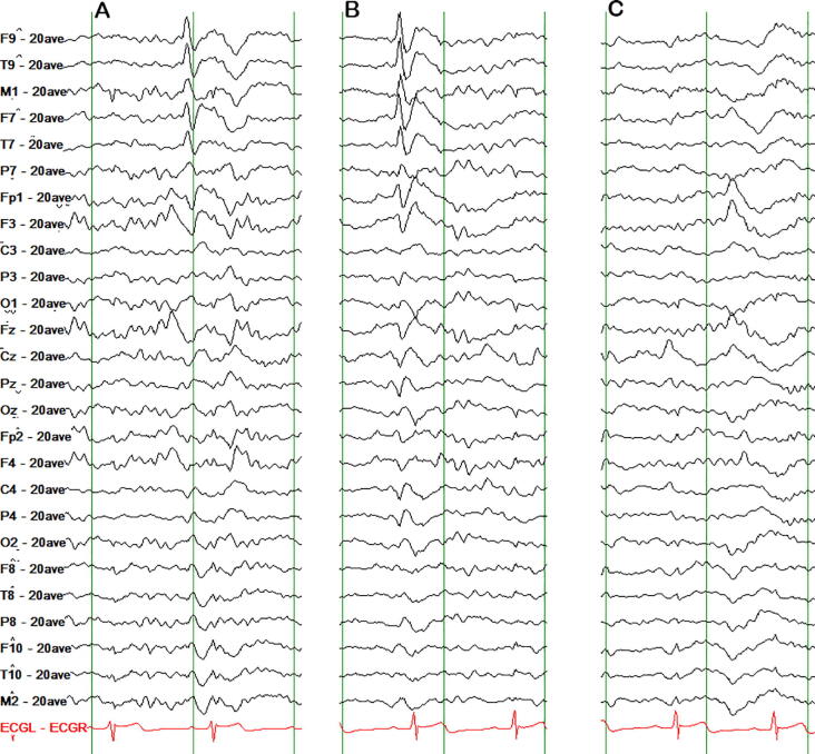 Laser Interstitial Thermal Therapy — Fig. 1