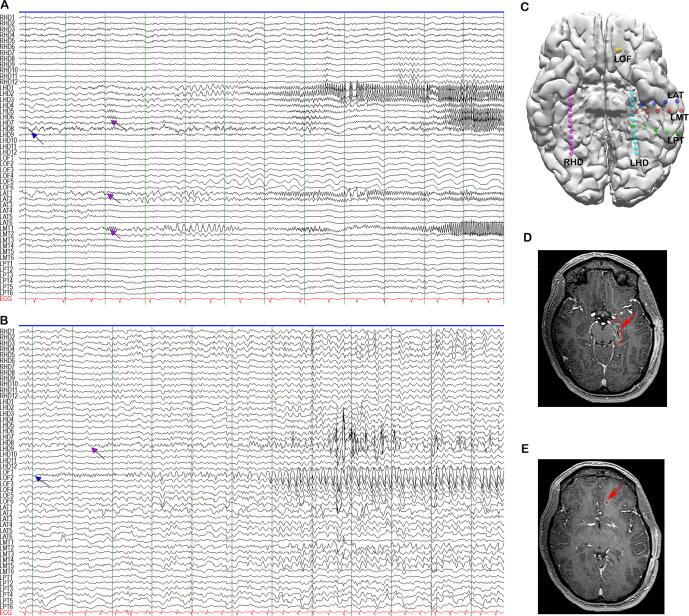 Laser Interstitial Thermal Therapy — Fig. 2