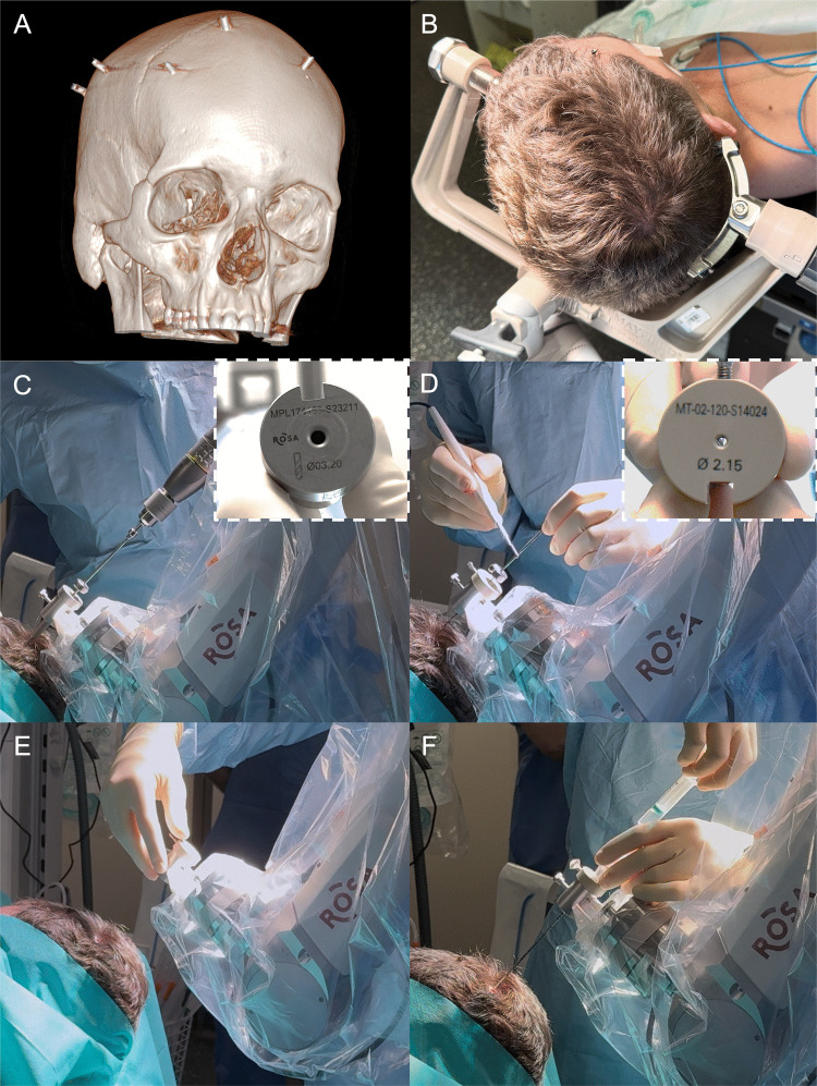 Laser Interstitial Thermal Therapy — Fig. 1
