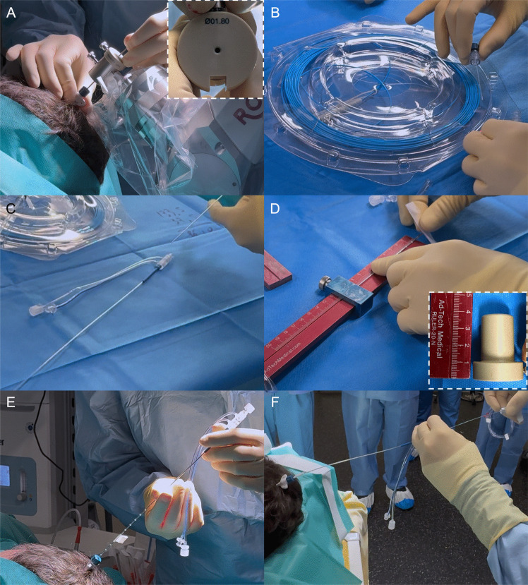 Laser Interstitial Thermal Therapy — Fig. 2
