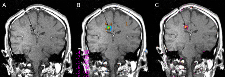 Laser Interstitial Thermal Therapy — Fig. 3