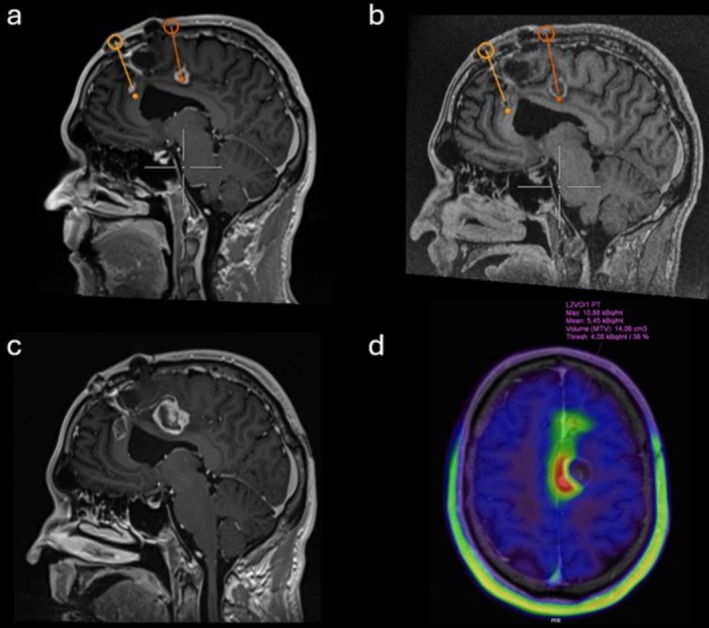 Laser Interstitial Thermal Therapy — FIGURE 1