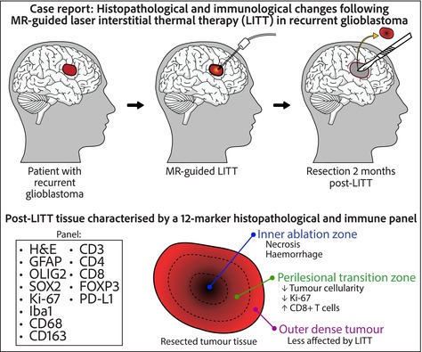 Laser Interstitial Thermal Therapy — Figure 8