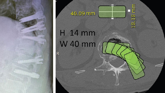 Lateral Lumbar Interbody Fusion — Figure 1