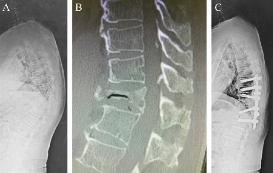 Lateral Lumbar Interbody Fusion — Figure 2
