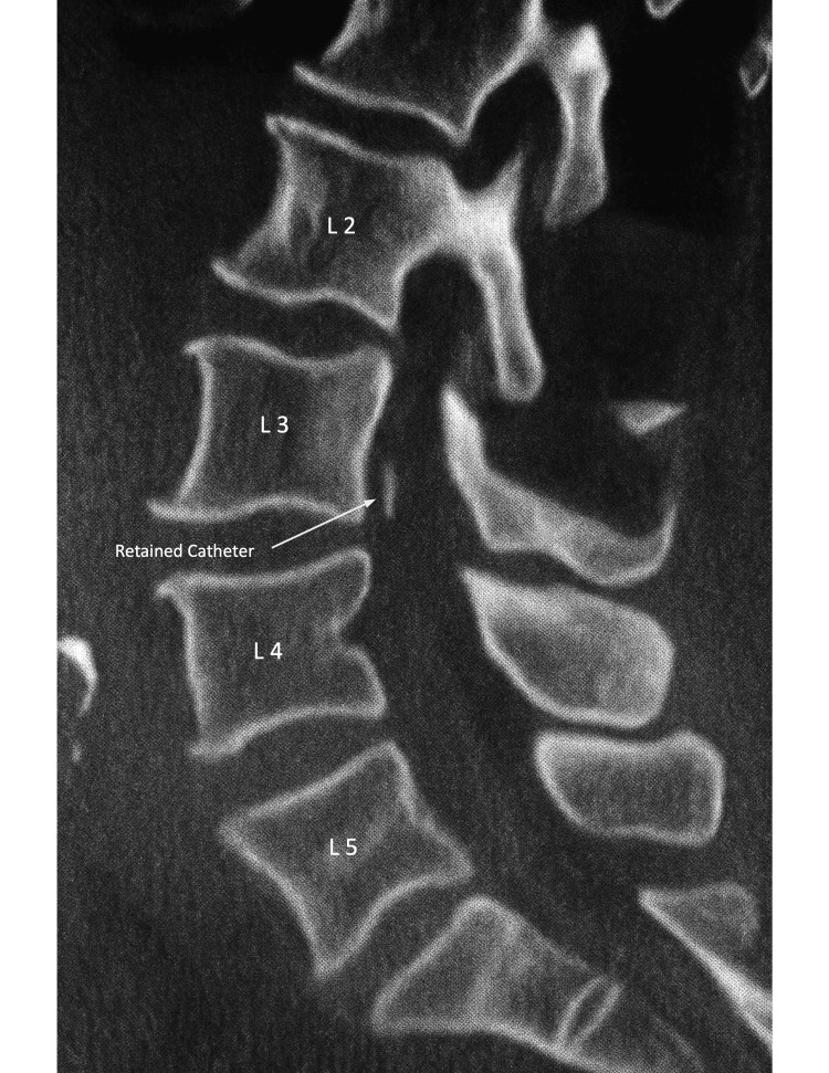Lumbar Drain Placement — Figure 1