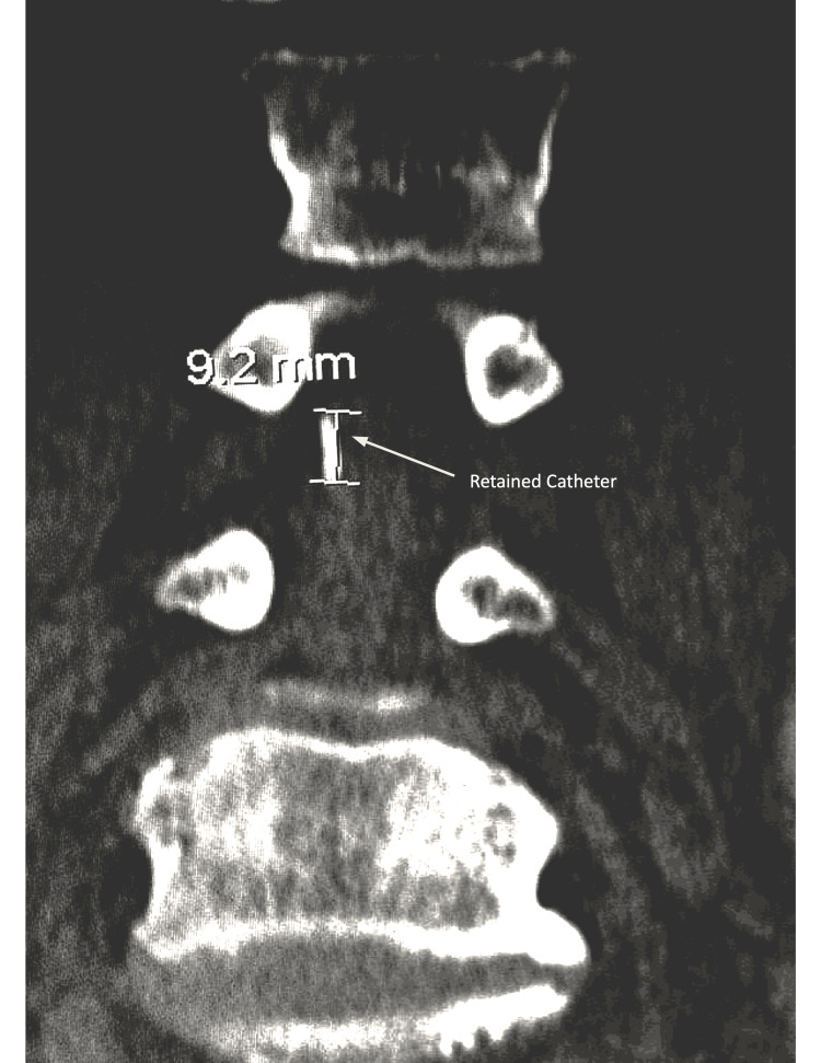 Lumbar Drain Placement — Figure 2