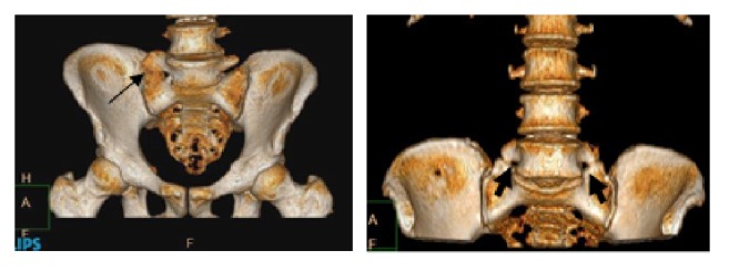 Lumbar Laminectomy Spinal Stenosis — Figure 1